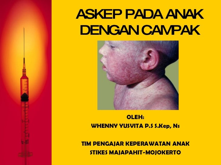 askep morbili